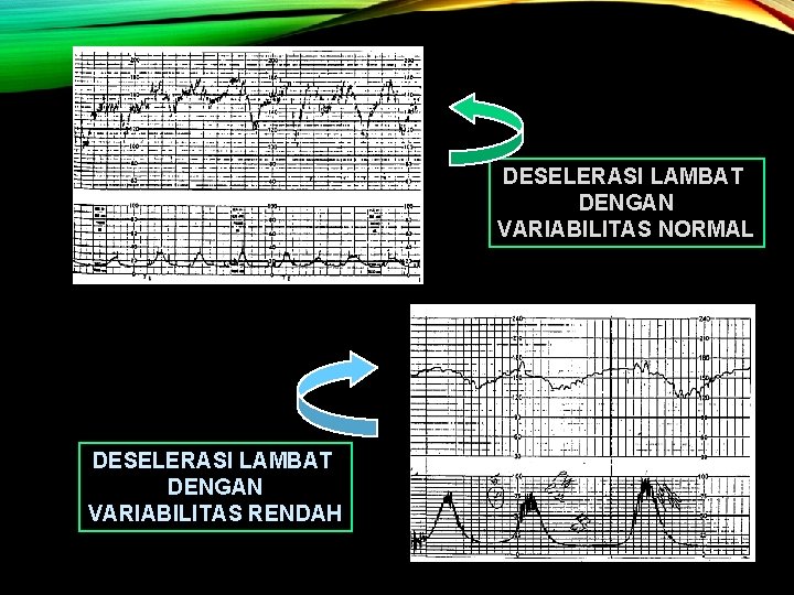 DESELERASI LAMBAT DENGAN VARIABILITAS NORMAL DESELERASI LAMBAT DENGAN VARIABILITAS RENDAH 