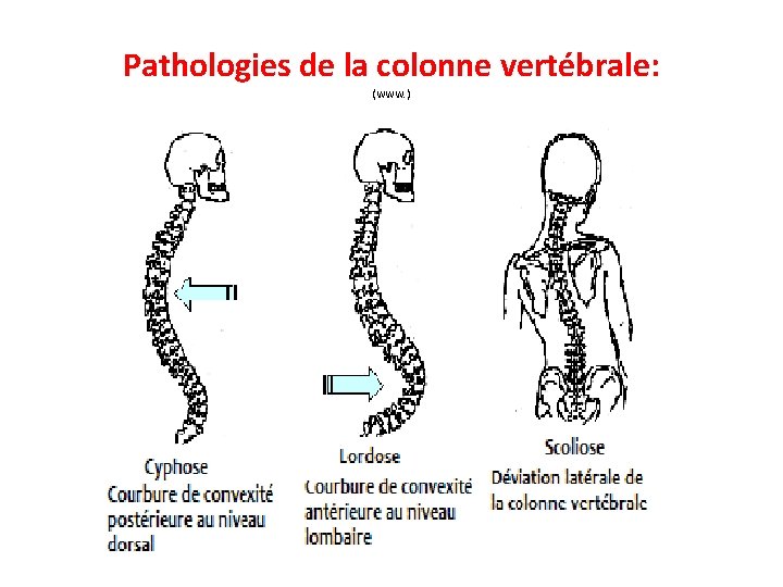 Pathologies de la colonne vertébrale: (www. ) 
