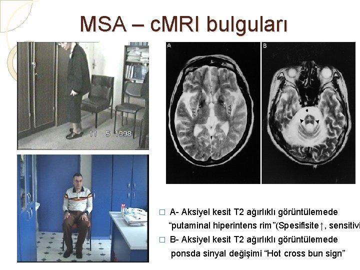 MSA – c. MRI bulguları � A- Aksiyel kesit T 2 ağırlıklı görüntülemede “putaminal