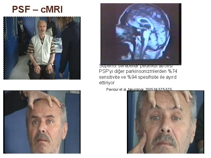 PSF – c. MRI Superior serebellar pedinkül atrofisi PSP’yi diğer parkinsonizmlerden %74 sensitivite ve