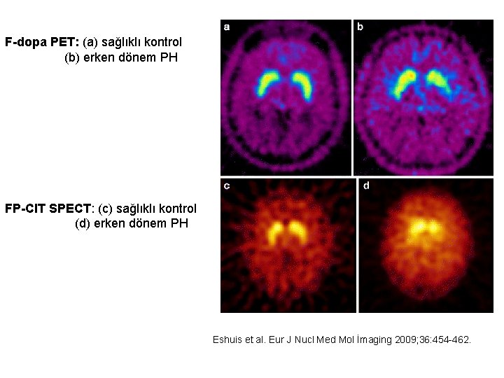 F-dopa PET: (a) sağlıklı kontrol (b) erken dönem PH FP-CIT SPECT: (c) sağlıklı kontrol