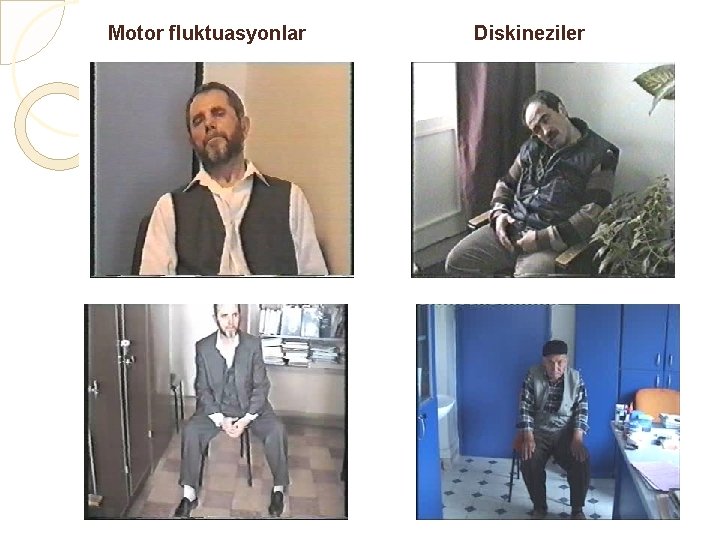 Motor fluktuasyonlar Diskineziler 