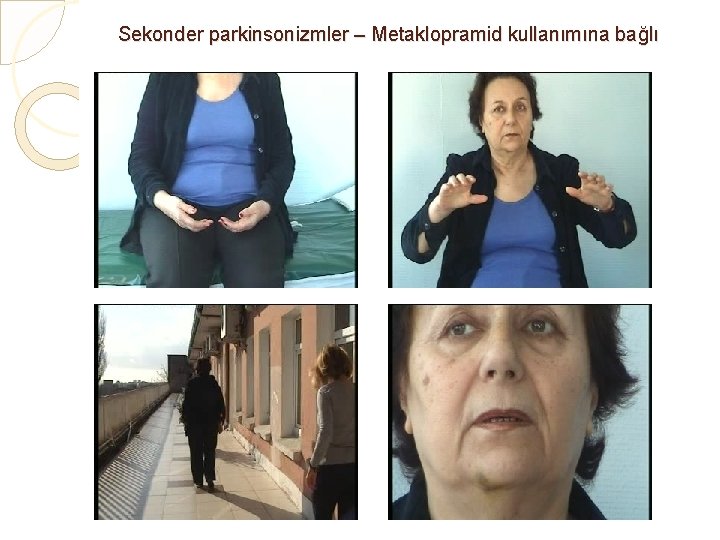 Sekonder parkinsonizmler – Metaklopramid kullanımına bağlı 