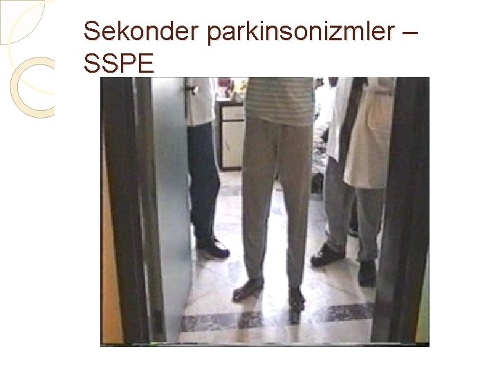 Sekonder parkinsonizmler – SSPE 