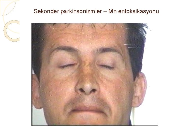 Sekonder parkinsonizmler – Mn entoksikasyonu 