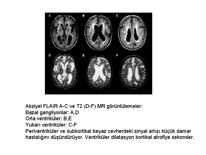 Aksiyel FLAIR A-C ve T 2 (D-F) MR görüntülemeler: Bazal gangliyonlar: A, D Orta