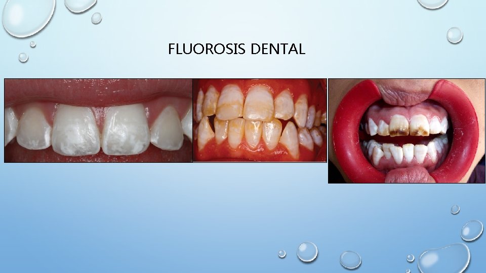 FLUOROSIS DENTAL 