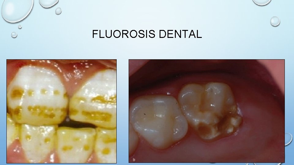 FLUOROSIS DENTAL 