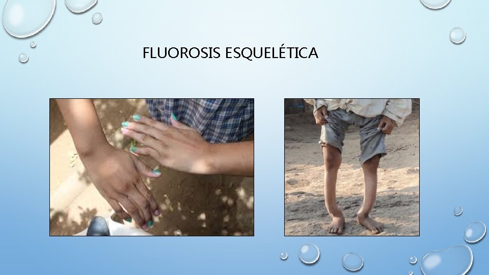 FLUOROSIS ESQUELÉTICA 