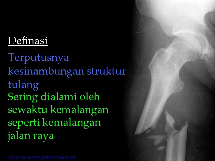 Definasi Terputusnya kesinambungan struktur tulang Sering dialami oleh sewaktu kemalangan seperti kemalangan jalan raya Definasi Terputusnya kesinambungan struktur tulang Sering dialami oleh sewaktu kemalangan seperti kemalangan jalan raya