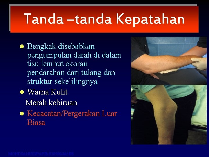 Tanda –tanda Kepatahan Bengkak disebabkan pengumpulan darah di dalam tisu lembut ekoran pendarahan dari