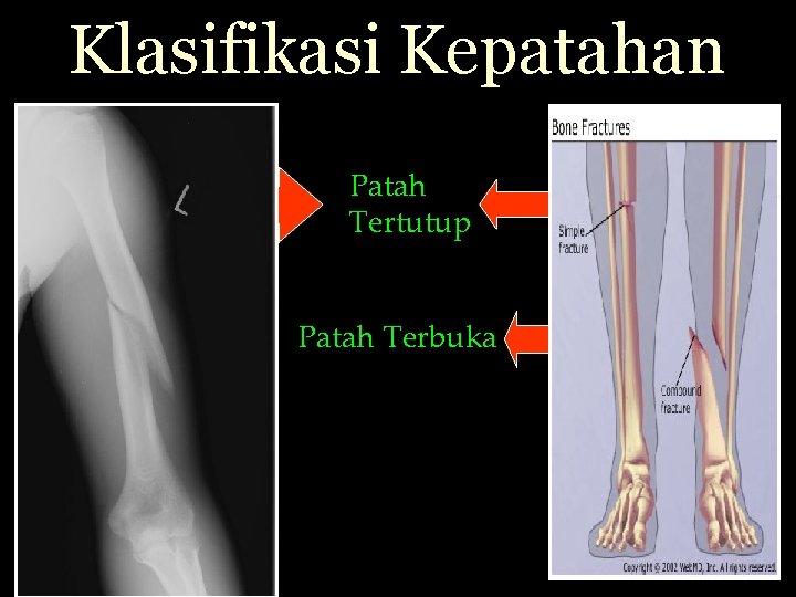 Klasifikasi Kepatahan Patah Tertutup Patah Terbuka 