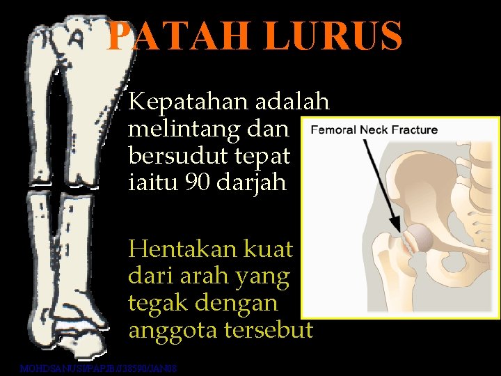 PATAH LURUS Kepatahan adalah melintang dan bersudut tepat iaitu 90 darjah Hentakan kuat dari