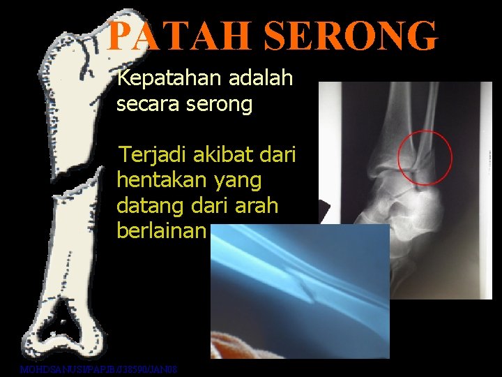 PATAH SERONG Kepatahan adalah secara serong Terjadi akibat dari hentakan yang datang dari arah