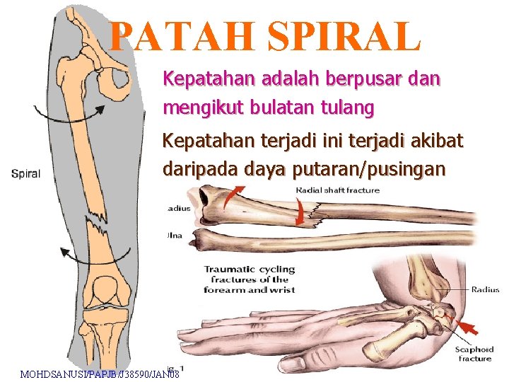 PATAH SPIRAL Kepatahan adalah berpusar dan mengikut bulatan tulang Kepatahan terjadi ini terjadi akibat PATAH SPIRAL Kepatahan adalah berpusar dan mengikut bulatan tulang Kepatahan terjadi ini terjadi akibat