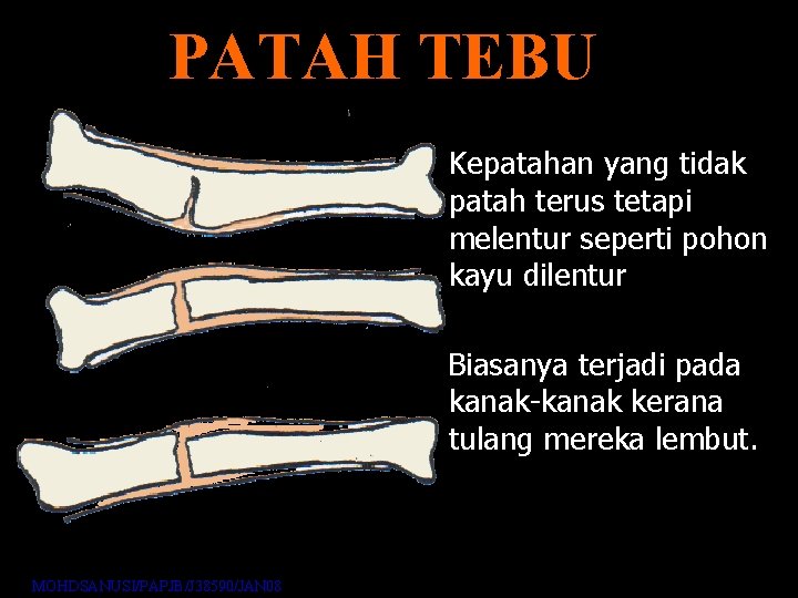 PATAH TEBU Kepatahan yang tidak patah terus tetapi melentur seperti pohon kayu dilentur Biasanya PATAH TEBU Kepatahan yang tidak patah terus tetapi melentur seperti pohon kayu dilentur Biasanya