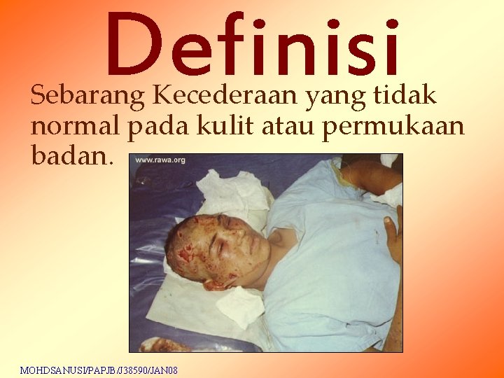 Definisi Sebarang Kecederaan yang tidak normal pada kulit atau permukaan badan. MOHDSANUSI/PAPJB/J 38590/JAN 08