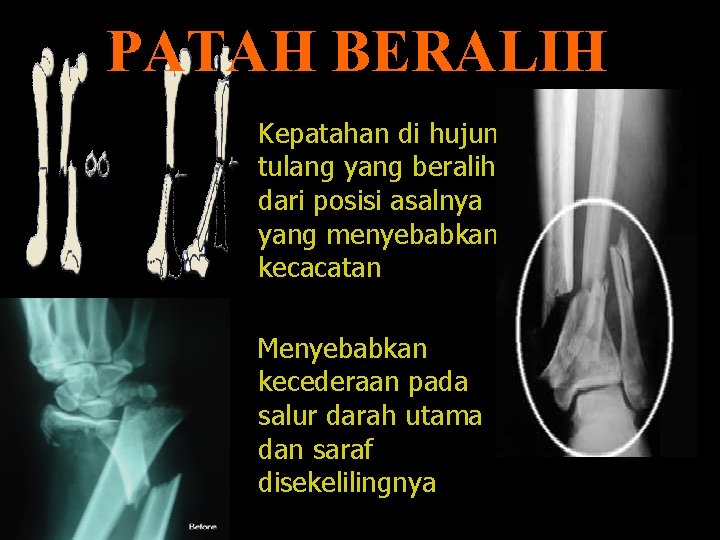 PATAH BERALIH Kepatahan di hujung tulang yang beralih dari posisi asalnya yang menyebabkan kecacatan PATAH BERALIH Kepatahan di hujung tulang yang beralih dari posisi asalnya yang menyebabkan kecacatan