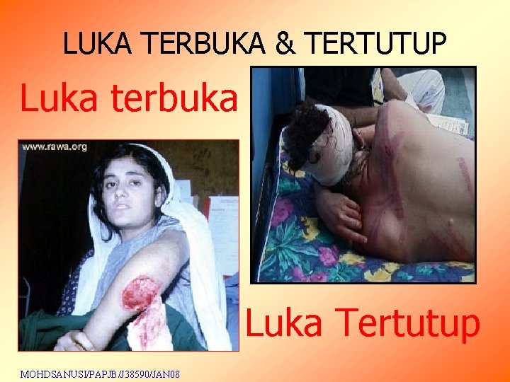 LUKA TERBUKA & TERTUTUP Luka terbuka Luka Tertutup MOHDSANUSI/PAPJB/J 38590/JAN 08 LUKA TERBUKA & TERTUTUP Luka terbuka Luka Tertutup MOHDSANUSI/PAPJB/J 38590/JAN 08