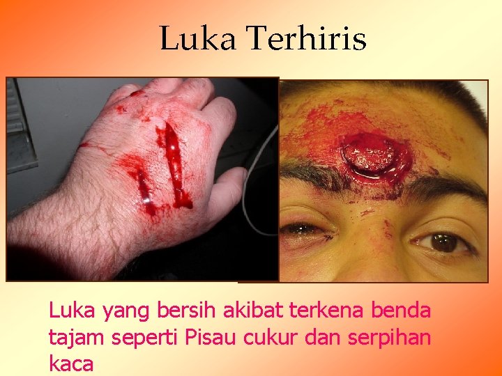Luka Terhiris Luka yang bersih akibat terkena benda tajam seperti Pisau cukur dan serpihan Luka Terhiris Luka yang bersih akibat terkena benda tajam seperti Pisau cukur dan serpihan
