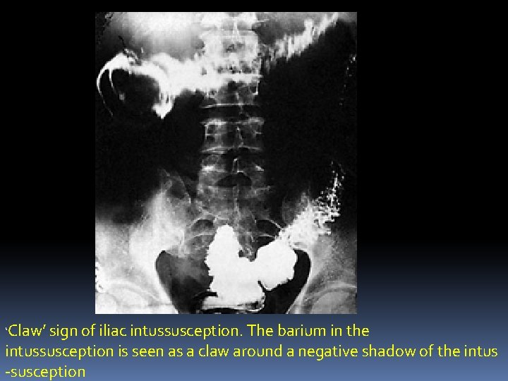 ‘Claw’ sign of iliac intussusception. The barium in the intussusception is seen as a