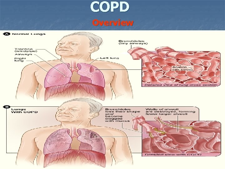 COPD Overview 