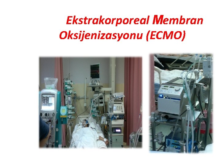 Ekstrakorporeal Membran Oksijenizasyonu (ECMO) 