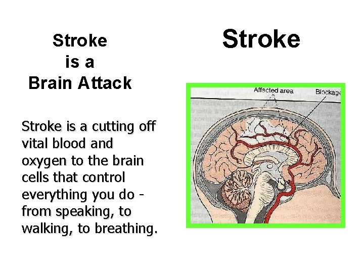 Stroke is a Brain Attack Stroke is a cutting off vital blood and oxygen