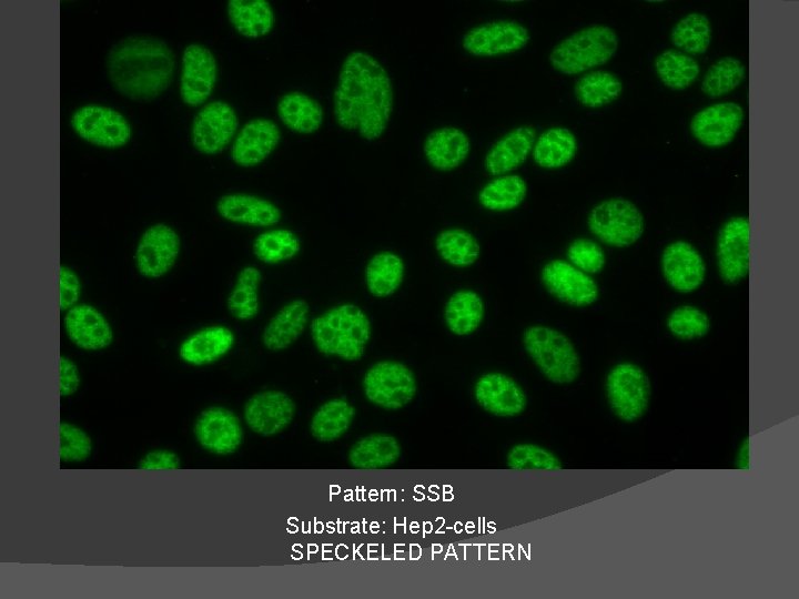 Pattern: SSB Substrate: Hep 2 -cells SPECKELED PATTERN 