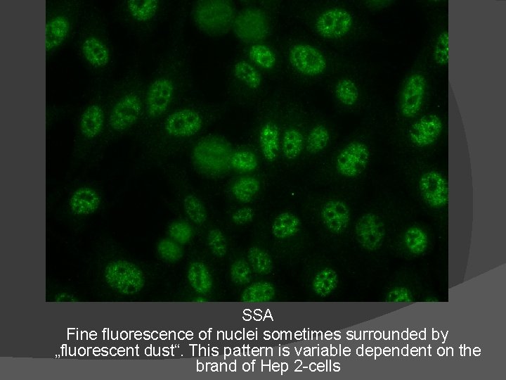 SSA Fine fluorescence of nuclei sometimes surrounded by „fluorescent dust“. This pattern is variable