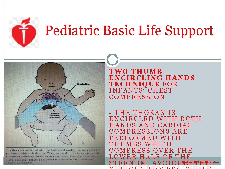 Pediatric Basic Life Support 25 TWO THUMBENCIRCLING HANDS TECHNIQUE FOR INFANTS’ CHEST COMPRESSION - Pediatric Basic Life Support 25 TWO THUMBENCIRCLING HANDS TECHNIQUE FOR INFANTS’ CHEST COMPRESSION -