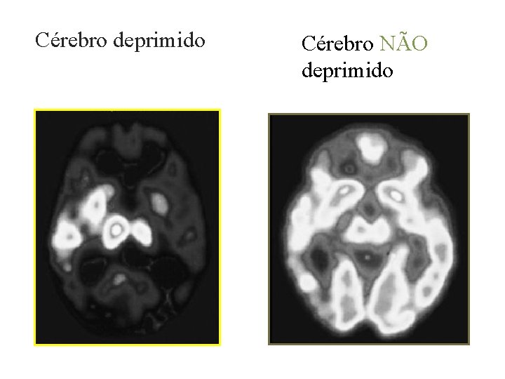 Cérebro deprimido Cérebro NÃO deprimido 