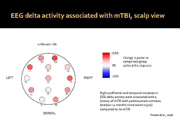 EEG delta activity associated with m. TBI, scalp view VENTRAL LEFT RIGHT DORSAL Right
