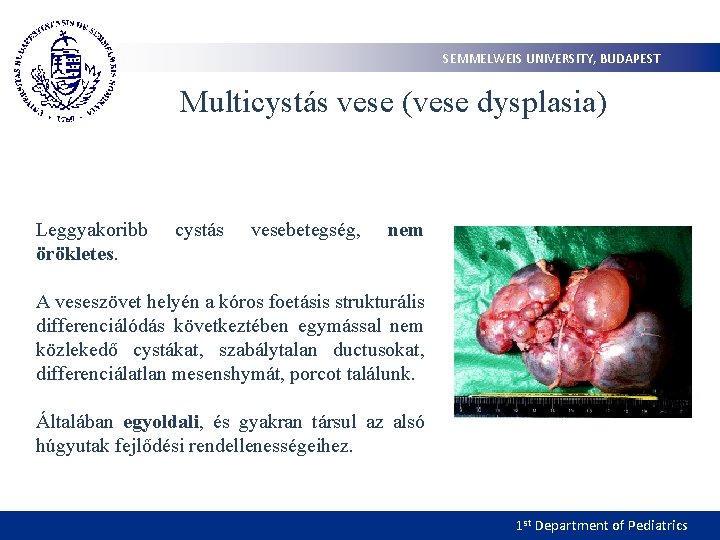 SEMMELWEIS UNIVERSITY, BUDAPEST Multicystás vese (vese dysplasia) Leggyakoribb örökletes. cystás vesebetegség, nem A veseszövet