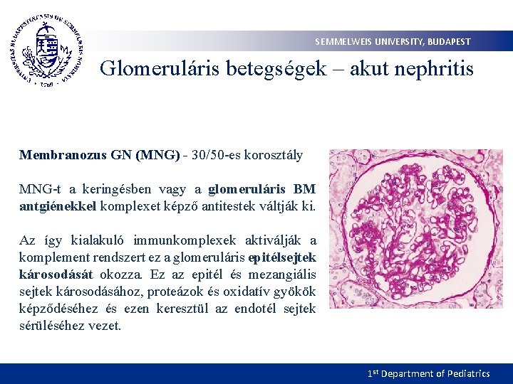 SEMMELWEIS UNIVERSITY, BUDAPEST Glomeruláris betegségek – akut nephritis Membranozus GN (MNG) - 30/50 -es