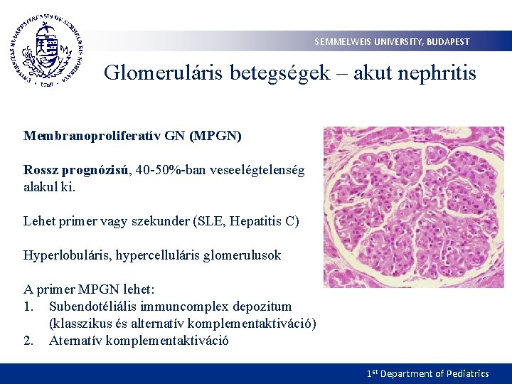 SEMMELWEIS UNIVERSITY, BUDAPEST Glomeruláris betegségek – akut nephritis Membranoproliferatív GN (MPGN) Rossz prognózisú, 40