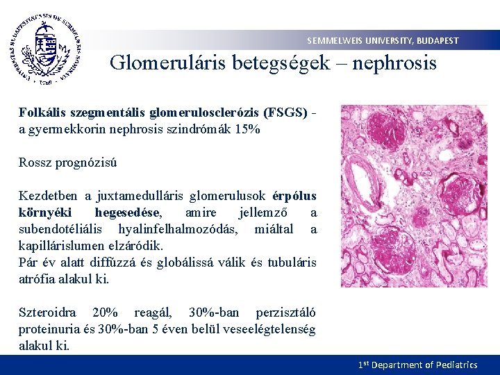 SEMMELWEIS UNIVERSITY, BUDAPEST Glomeruláris betegségek – nephrosis Folkális szegmentális glomerulosclerózis (FSGS) a gyermekkorin nephrosis