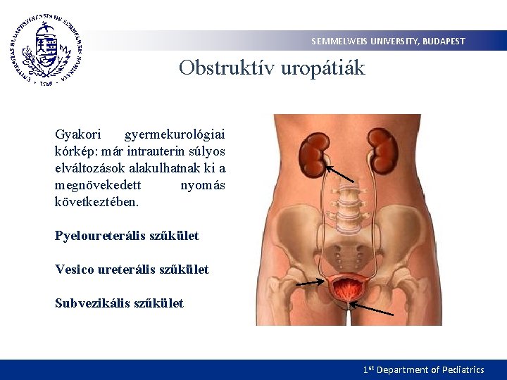 SEMMELWEIS UNIVERSITY, BUDAPEST Obstruktív uropátiák Gyakori gyermekurológiai kórkép: már intrauterin súlyos elváltozások alakulhatnak ki