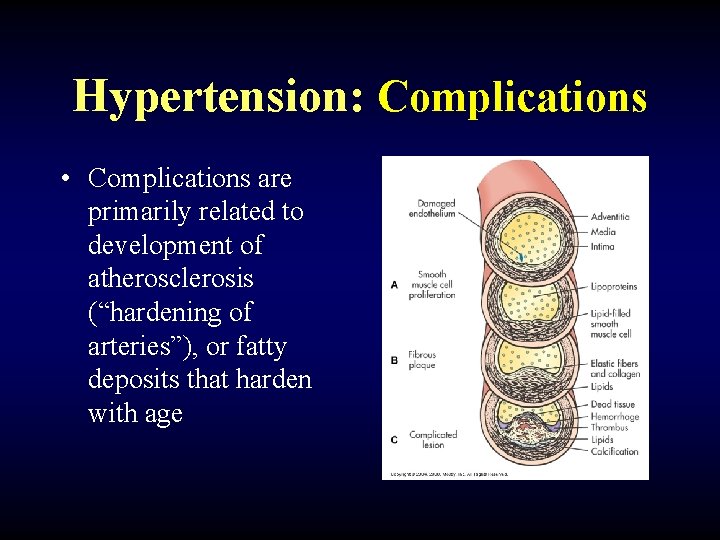 Hypertension: Complications • Complications are primarily related to development of atherosclerosis (“hardening of arteries”),