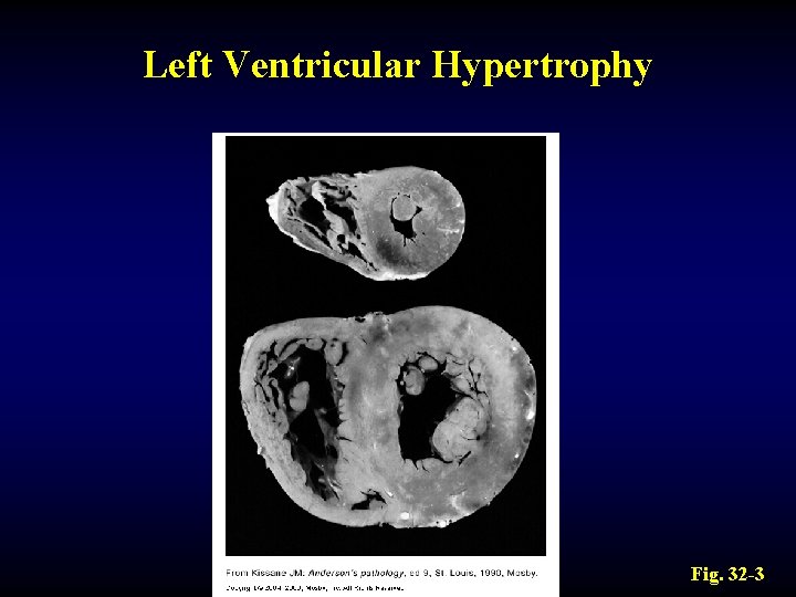 Left Ventricular Hypertrophy Fig. 32 -3 