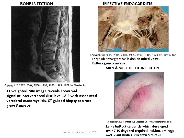 BONE INFECTION INFECTIVE ENDOCARDITIS Large ulcerovegetative lesion on mitral valve. Culture grew S. aureus