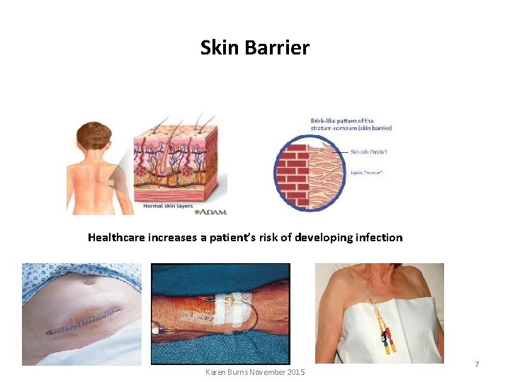 Skin Barrier Healthcare increases a patient’s risk of developing infection Karen Burns November 2015