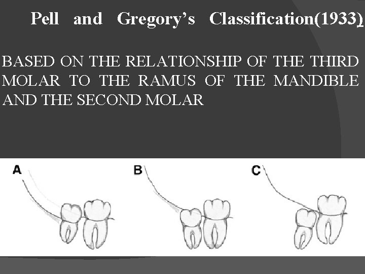 Pell and Gregory’s Classification(1933) BASED ON THE RELATIONSHIP OF THE THIRD MOLAR TO THE