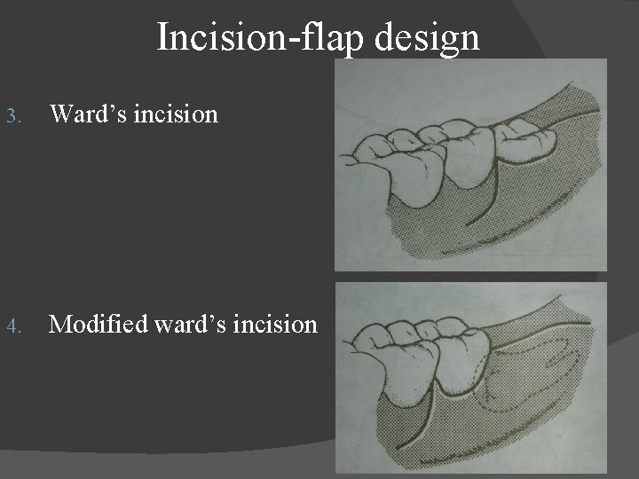  Incision-flap design 3. Ward’s incision 4. Modified ward’s incision 