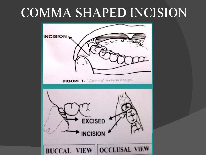  COMMA SHAPED INCISION 