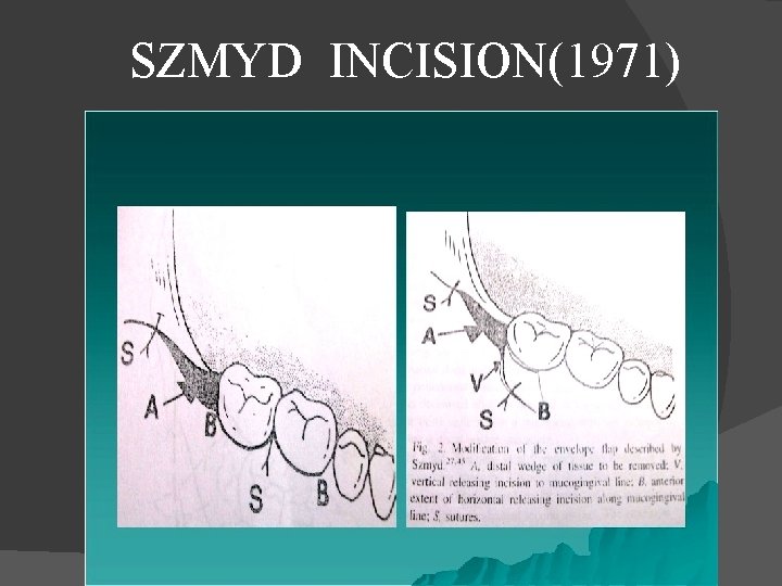  SZMYD INCISION(1971) 