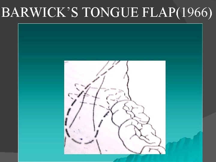 BARWICK’S TONGUE FLAP(1966) 