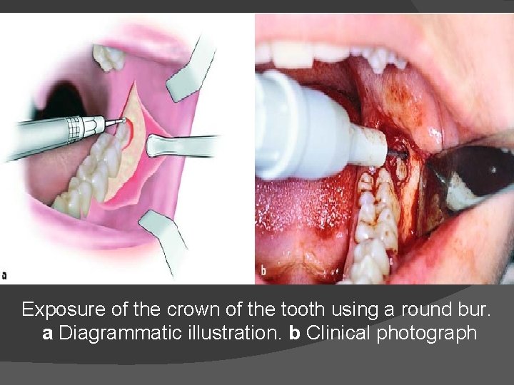 Exposure of the crown of the tooth using a round bur. a Diagrammatic illustration.