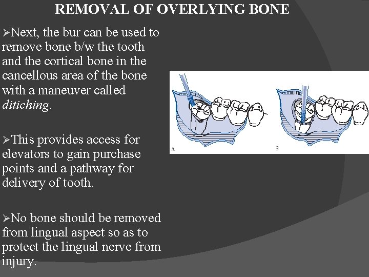 REMOVAL OF OVERLYING BONE ØNext, the bur can be used to remove bone b/w