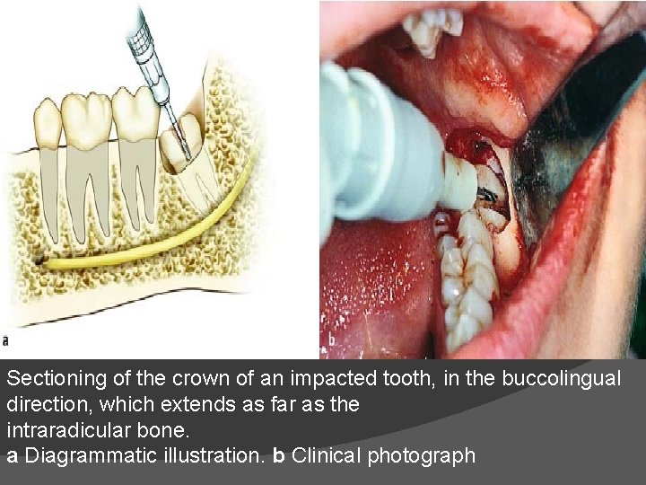 Sectioning of the crown of an impacted tooth, in the buccolingual direction, which extends